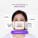 거상환경 | 미니거상후기 탄력 보완 회복 과정