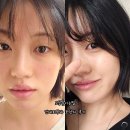 연세봄의료기기 | 건대피부과 포텐자 얼굴 모공축소 후기 통증 효과 모공줄이는법