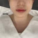 퍼펙트더블유 | [대구/ 수성구] 유아이 에스테틱, 물광, 하이푸 관리 후기