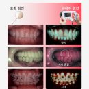 대방치과의원 | 신대방역 치과 추천 크라운 씌운 치아 또 아파요