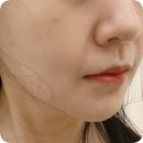 신창로 | 광주 피부관리 더맑은스킨 광주신창점 하이푸리프팅 만족 후기