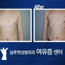 아주 작은 남성유방비대증 이런것도 제거 가능 이미지