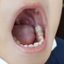 7살 형아 불소도포