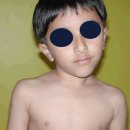 congenital Torticollis 이미지