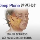 바깔 | 안면거상 부작용 '넙치상' 되돌릴 수 있을까..? (원인, 수술법)