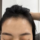 용의원 | 30대 여성 헤어라인 모발이식 1년 후기 - 용닥터의원 (내돈내산)