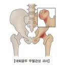 대퇴골두무혈성괴사증자연치유 이미지