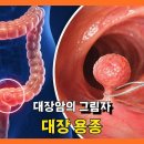 대장암의 그림자 대장용종 이미지
