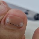 장안19 | 장안동발톱관리 장인 바이오풋케어 장안점