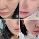 강남 레디어스 가격 팔자주름 효과 3주 차 후기