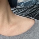 [쥐젖 제거] 오로지 목사진뿐인 쥐젖 실면도제거후기(약간의 혐오주의,,)