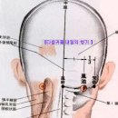 부황 - 담결림을 풀어주는 부항 이미지