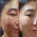 프로로재생의원 | [압구정로데오병원]리얼젝션 잔주름킬러 시술 후기