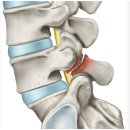 척추분리증 신체급수 기준 해설 이미지