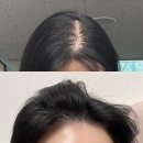 하남우리들약국 | [하남 미사 여자 탈모약 처방]1년치 먹는 미녹시딜+비오틴 후기(부작용)