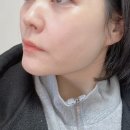 나나복싱 | 강남 눈밑지방재배치레이저로 절개없이 눈밑지방제거 성공한 후기