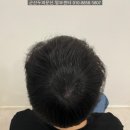 정수리 이미지
