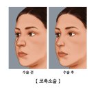코 이미지