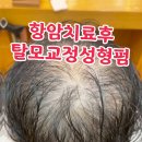 “2022년 모발수술과 두피페인팅으로도 채워지지 않았던 탈모… 탈모교정성형펌을 만난 후 4년째 단골이 된 이유!” 이미지