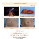 담낭용종수술후기. 지난 10월 종합검진상 담낭용종이 크게 자라 병원을 알아보던 중 튼튼병원 후기가 좋아 방문하였습니다. 이미지