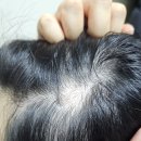 엠디피부과의원 | 평택역 피부과 원형탈모 치료 후기, “엠디피부과” 진료비용 및 과정