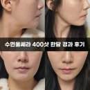 압구정리프팅 수면울쎄라 400샷 + 스킨부스터 리쥬란, 튠페이스, 튠라이너 피부 플랜업 후기