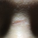 28140-3-6-19 | 패인흉터 19탄 이대역한의원 이대역새살침 15년 새살침장인 마지막 후기