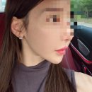 자연차 | 신사역성형외과 미니리프팅 3개월차 후기, 자연스러운 변화가 만족스러웠던 이유