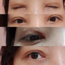 눈의꽃성형외과의원 | 강남구 성형외과 눈재수술 잘하는 곳 후기보고 결정하면 안된다?
