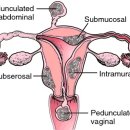자궁근종[myoma uteri] 이미지