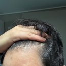 당당한 삶 | 모발이식 140일 리얼 후기! 땀 흘려도 당당한 볼륨감, 탈모 고민 싹 사라졌네요