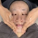 역적로1R-1 | 강남구청역 피부과 티타늄 리프팅 후기 :: 청담 안즈 피부과