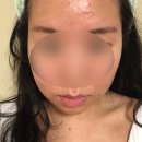 잠실피부과 여드름 지루성피부염 전문 ‘잠실 예안피부과’추천 인텐스 진정관리