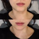 스노우의원 - 고양시 일산동구 중앙로1261번길 61 | 파주 운정 이중턱 온다리프팅 4회차 후기 l 스노우의원 온다리프팅