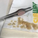 피부과 후기 (1) | Co2 비립종, 편평 사마귀 무제한 제거, 경과 후기 (라르떼의원)