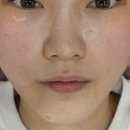메이퓨어 피부과 :: 피코토닝 + IPL + 리비힐 스킨부스터 샤이닝 // co2 레이져
