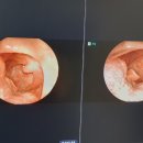 성우메디칼 | 압구정로데오 이비인후과 추천? &#39;부은 림프&#39;까지 눈으로 본 리얼 치료 과정