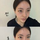 서클 | 대구피부과 눈밑꺼짐 다크서클 미희주사 후기 내돈내산