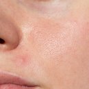 레보필의원 | 피지 잡겠다고 더 망쳤던 피부 방향 하나 바꾸니 달라졌습니다