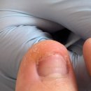 닥터페디 해운대장산점 | 부산 해운대 내성발톱 닥터페디해운대장산점 파고드는 발톱 관리 후기