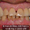 희망을심는치과의원 | 후기] 아래 앞니와 어금니 전체적으로 아랫니 임플란트 진행해 드린 후기, 광명 전체 임플란트 치과