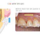 이가 시린 이유 시릴때 이시림 원인 치료 방법 이미지