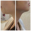 슈링톡스의원 | 올타이트닝 리프팅 후기 리프팅 시술 비교정리 (+슈링톡스의원 ) 내돈내산후기