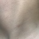 하나삼성의원 | ❗️응대 최악 실력 최악 밴스의원 삼성 후기 (편사제거, 모공톡신)