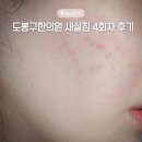 차서역침한의원 | 얼굴 패인흉터 새살침 내돈내산 도봉구피부과 한의원 4회차 후기