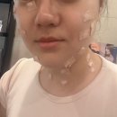 라르떼의원 | 수유 피부과 라르떼의원 점제거 내돈내산 후기✨ 1100원 가성비최고