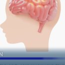 모야모야 | [모야모야병] 수술후기 ! (4)