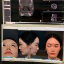 코재수술 잘하는곳 서울 양재 프레쉬이비인후과 수술10일차 내돈내산