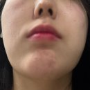 귀족PC방 | [내돈내산] 신논현역 귀족수술 / 일주일 경과 후기