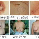 유방암에 대하여 이미지